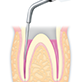 NSK E7 Endo Aufsatz Satelec Dental