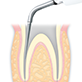 NSK Varios Ultraschall-Chirugie-Aufsätze E7D Endodontie Dental Depot